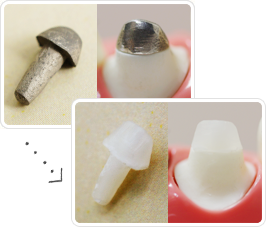 金属は歯よりも硬くむし歯の再発や歯が割れる原因となります