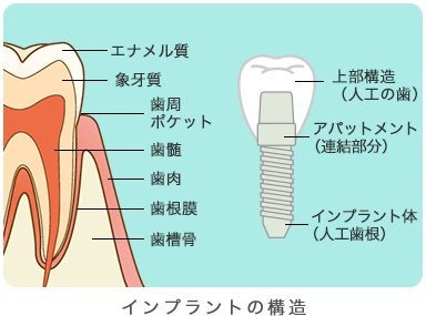 インプラントの構造について