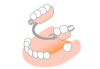 部分入れ歯