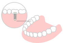 インプラント