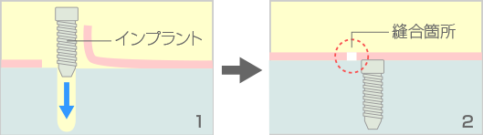 歯科用インプラントの埋入手術・治癒期間""