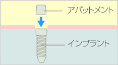 アバットメント（歯の土台）の取り付け